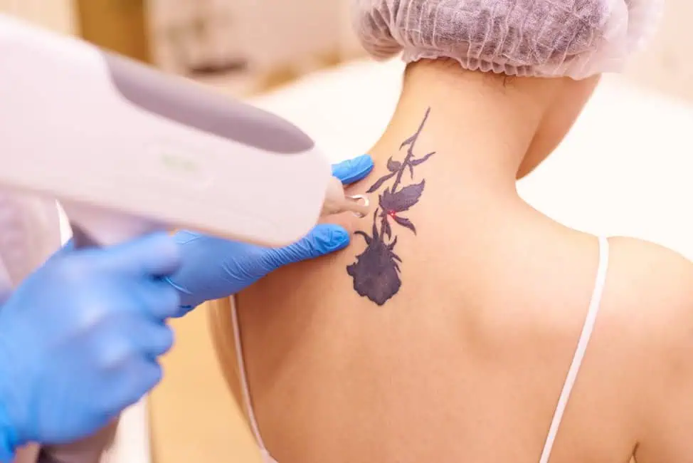 Laser Tattoo Removal by Dr. Addison Aesthetics in Cary, NC