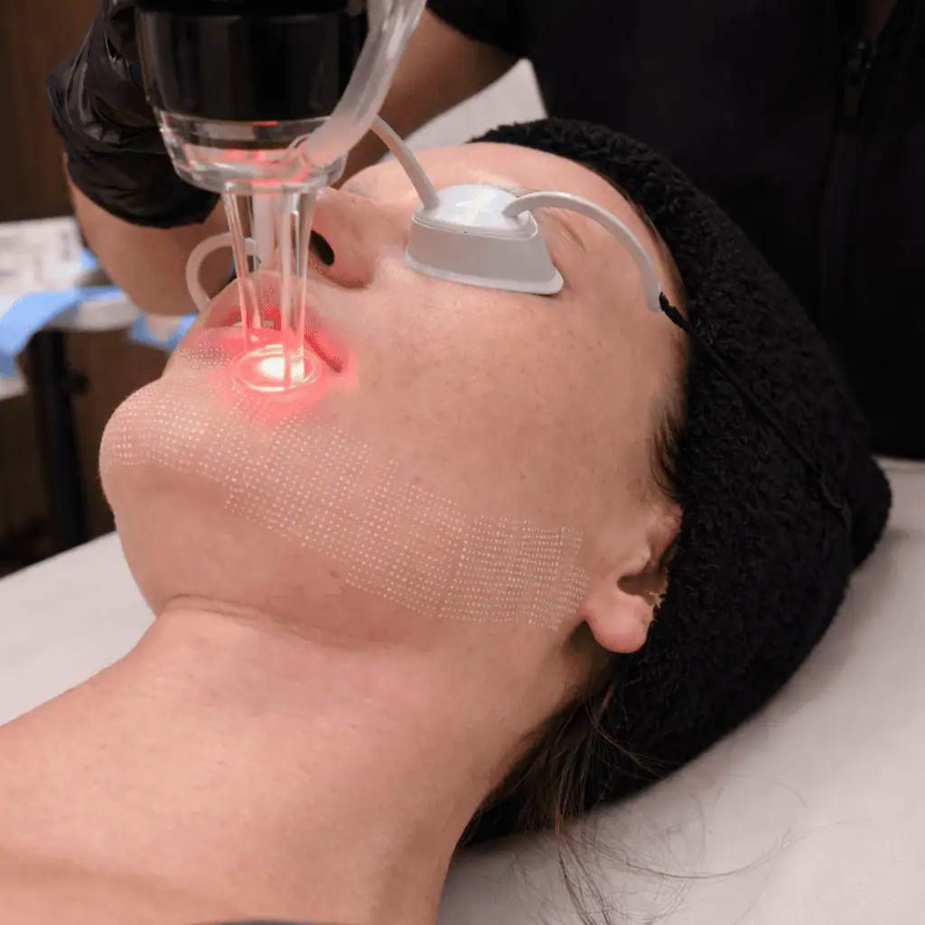 CO₂ Laser Skin Resurfacing