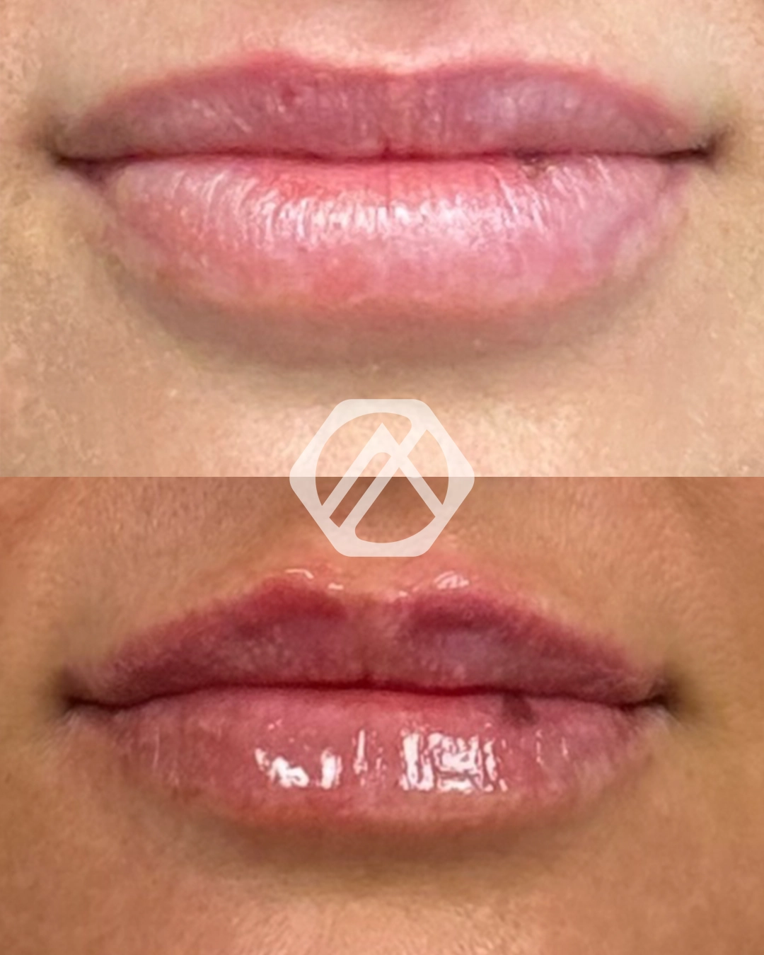 Lip filler