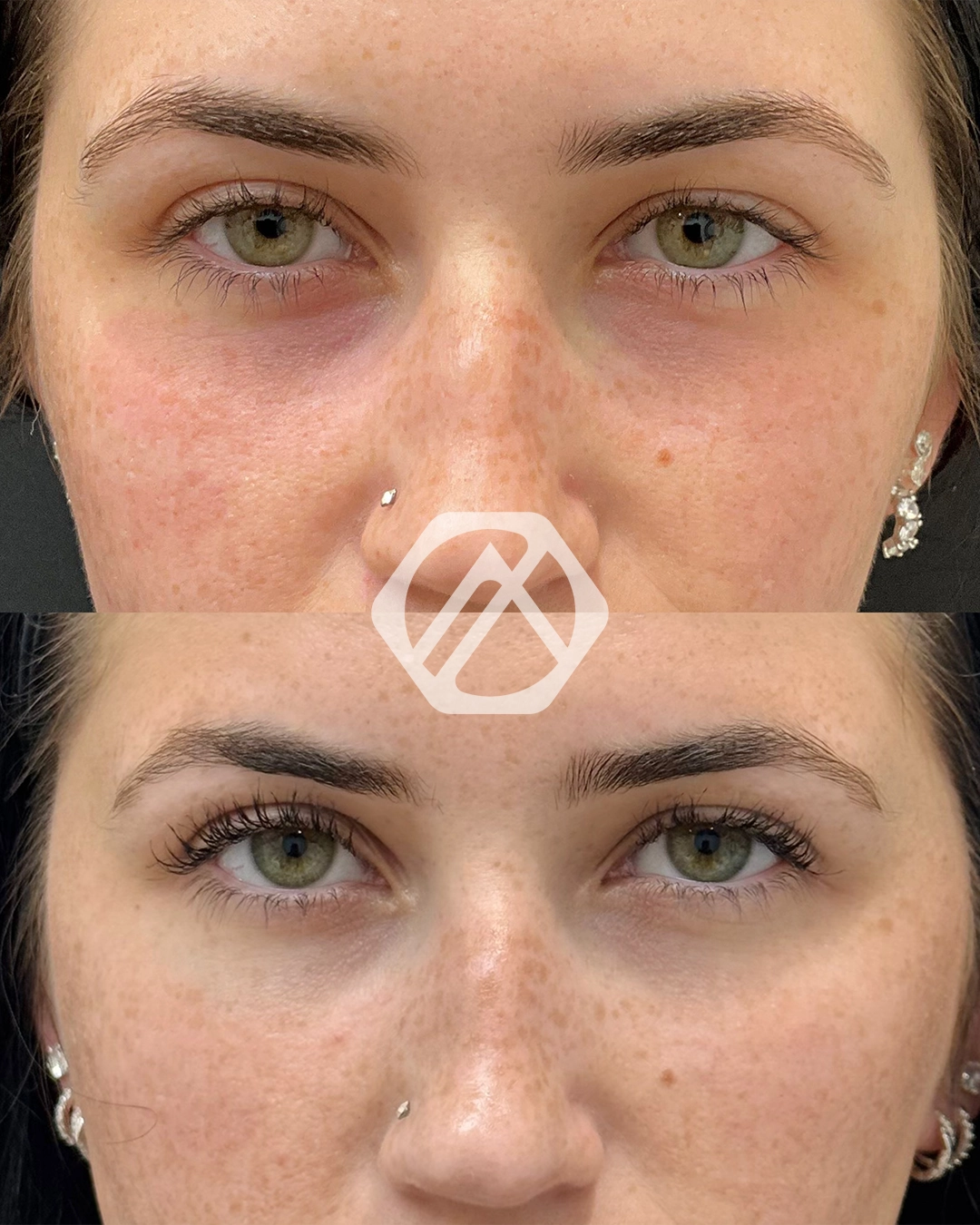 Undereye