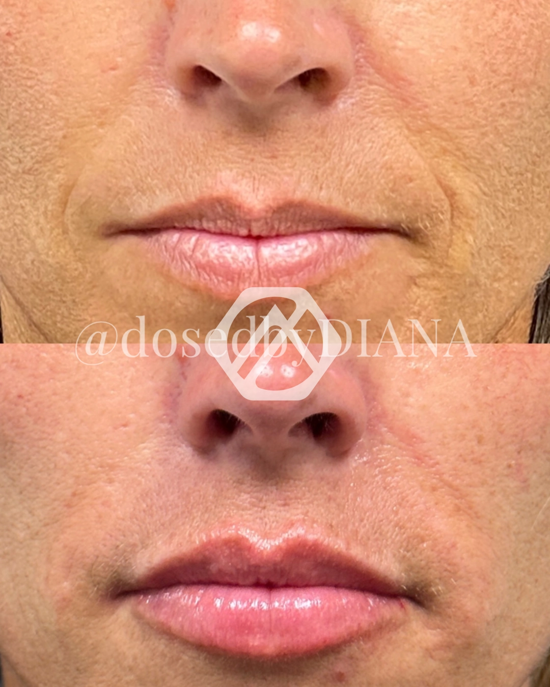 Lip filler