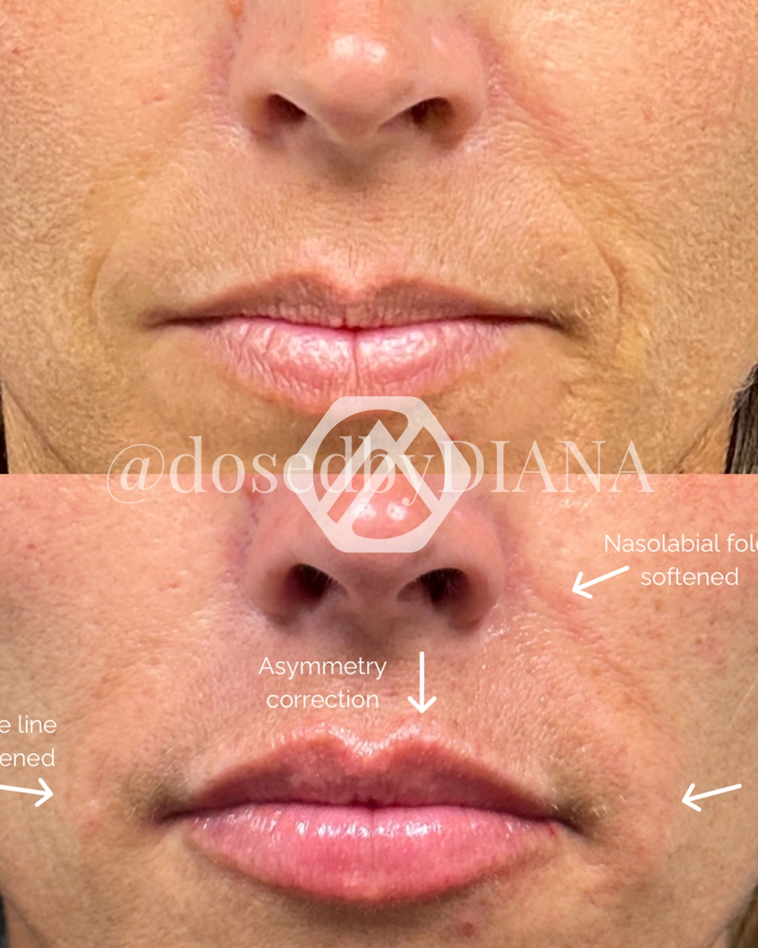 Lip filler