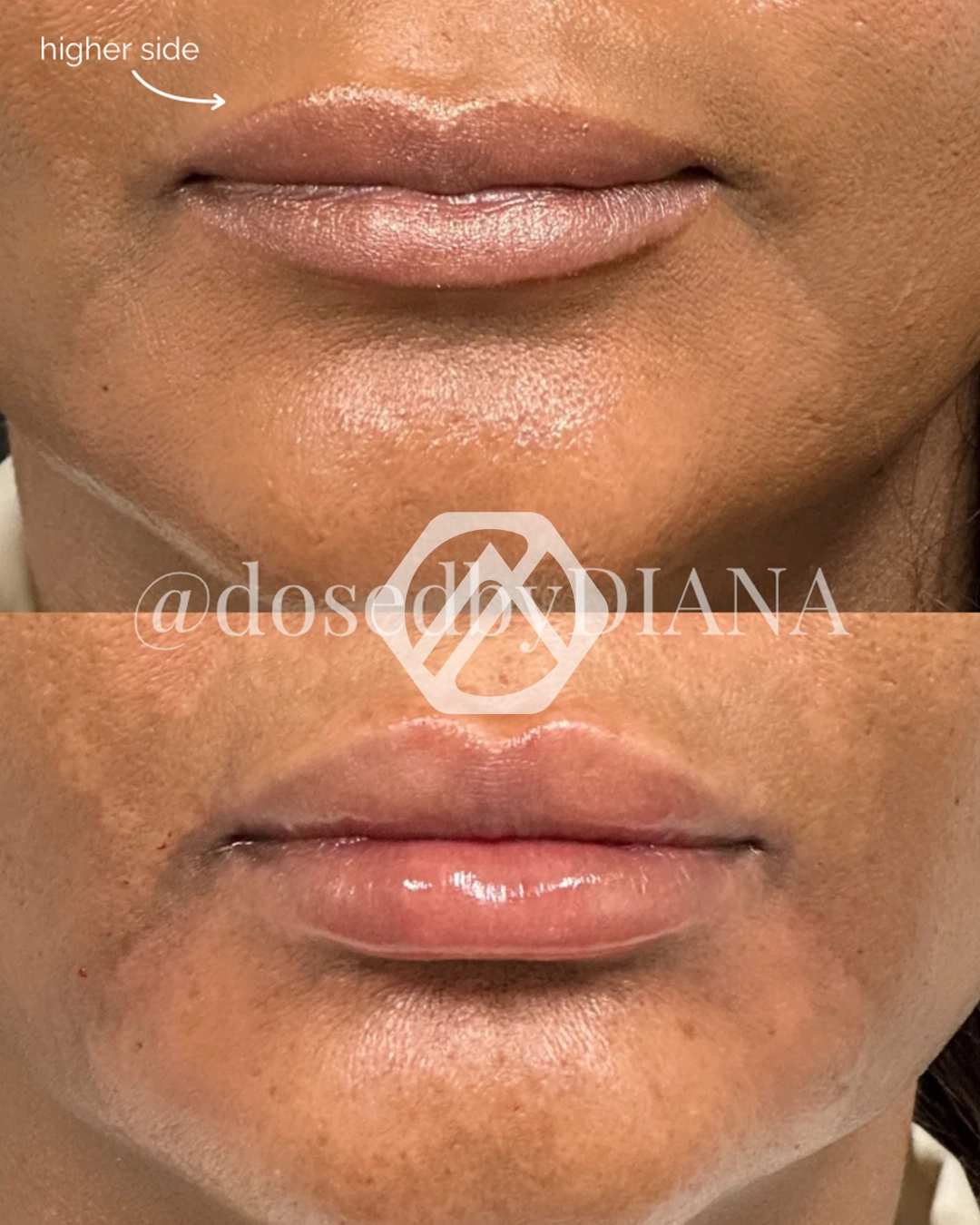 Lip filler