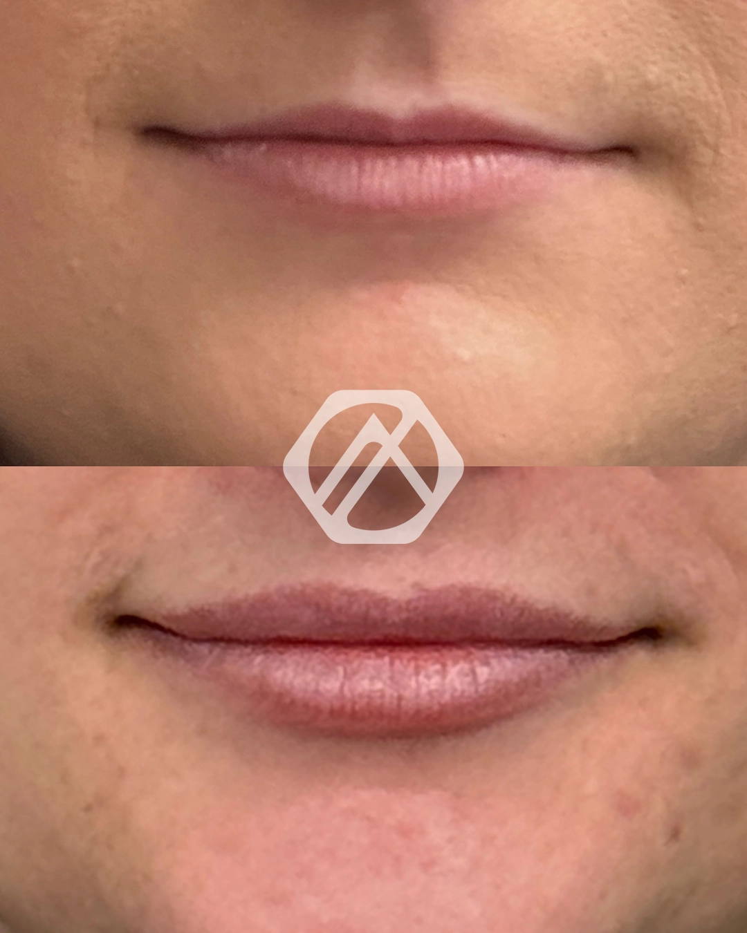 Lip filler