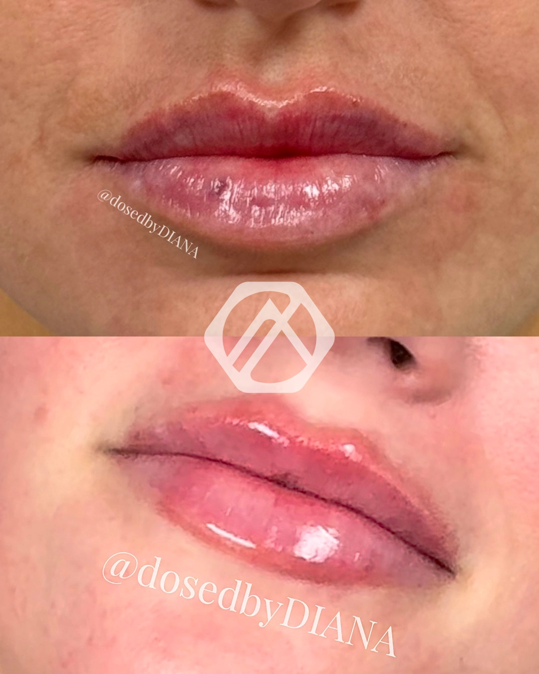 Lip filler