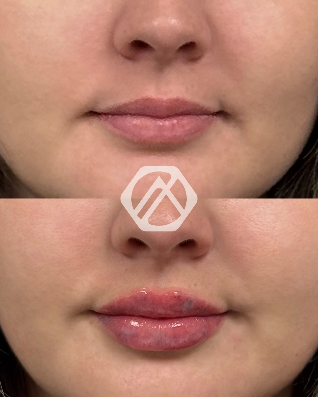 Lip filler