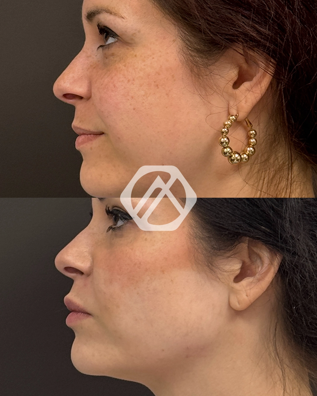 Facial Balancing