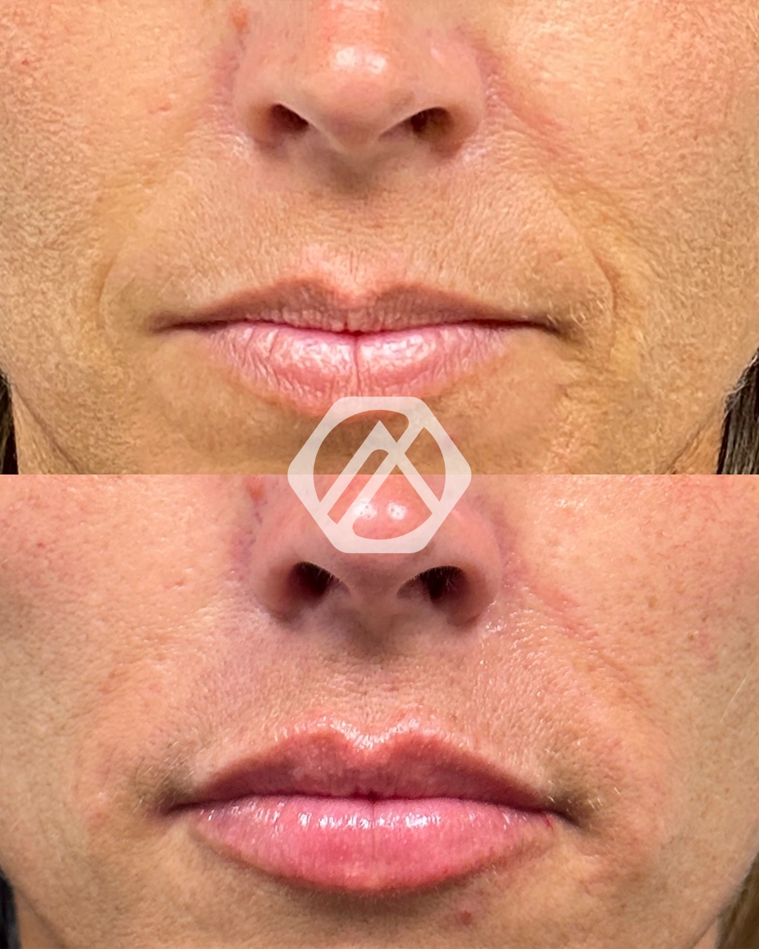 Lip filler