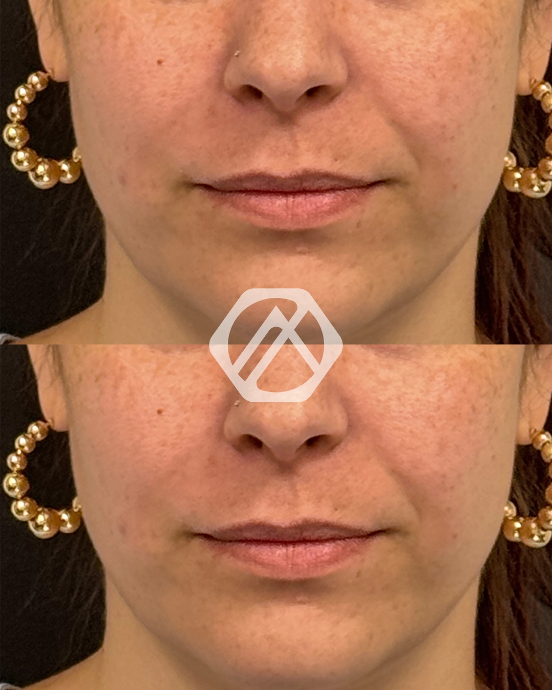 Facial Balancing