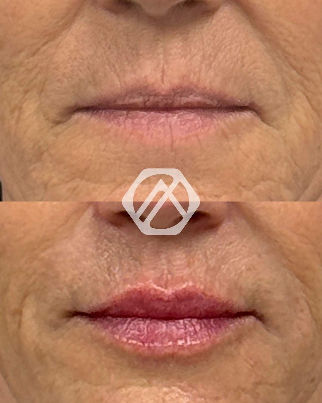 Lip filler