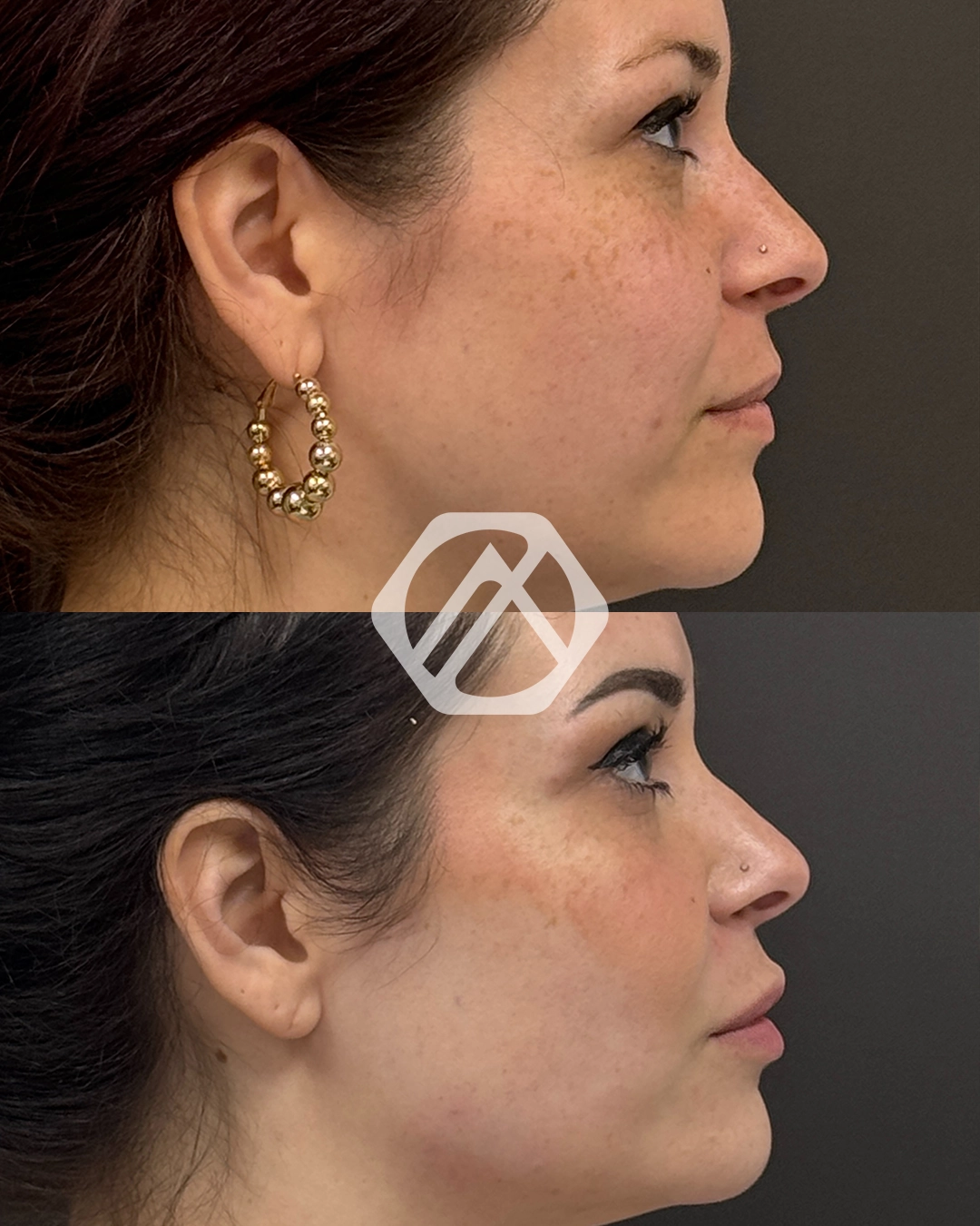 Facial Balancing