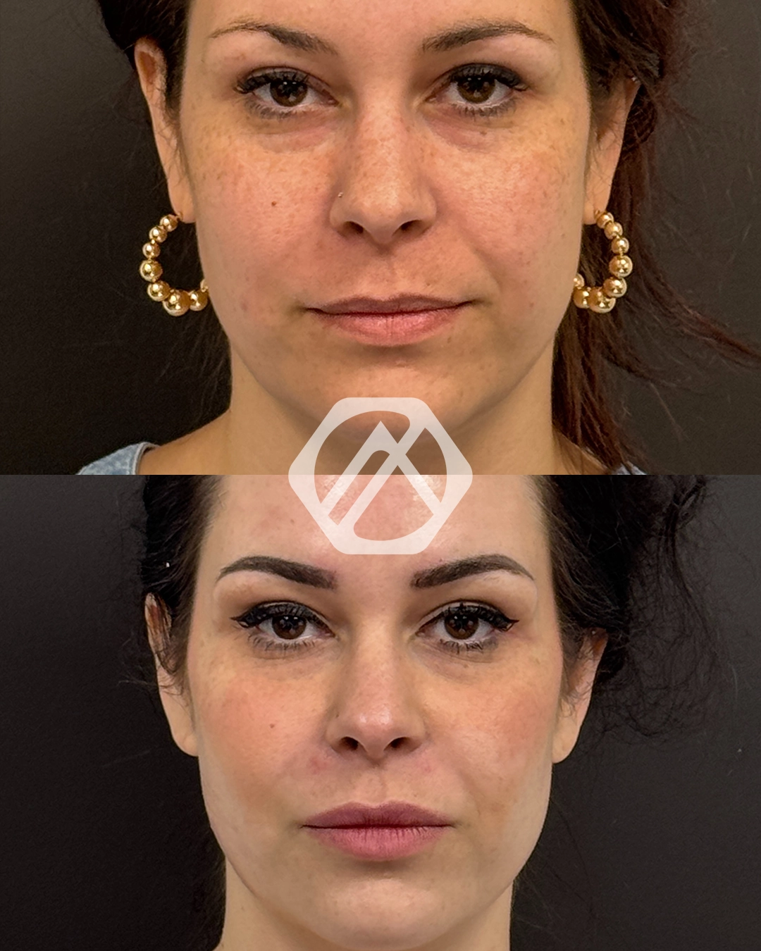 Facial Balancing