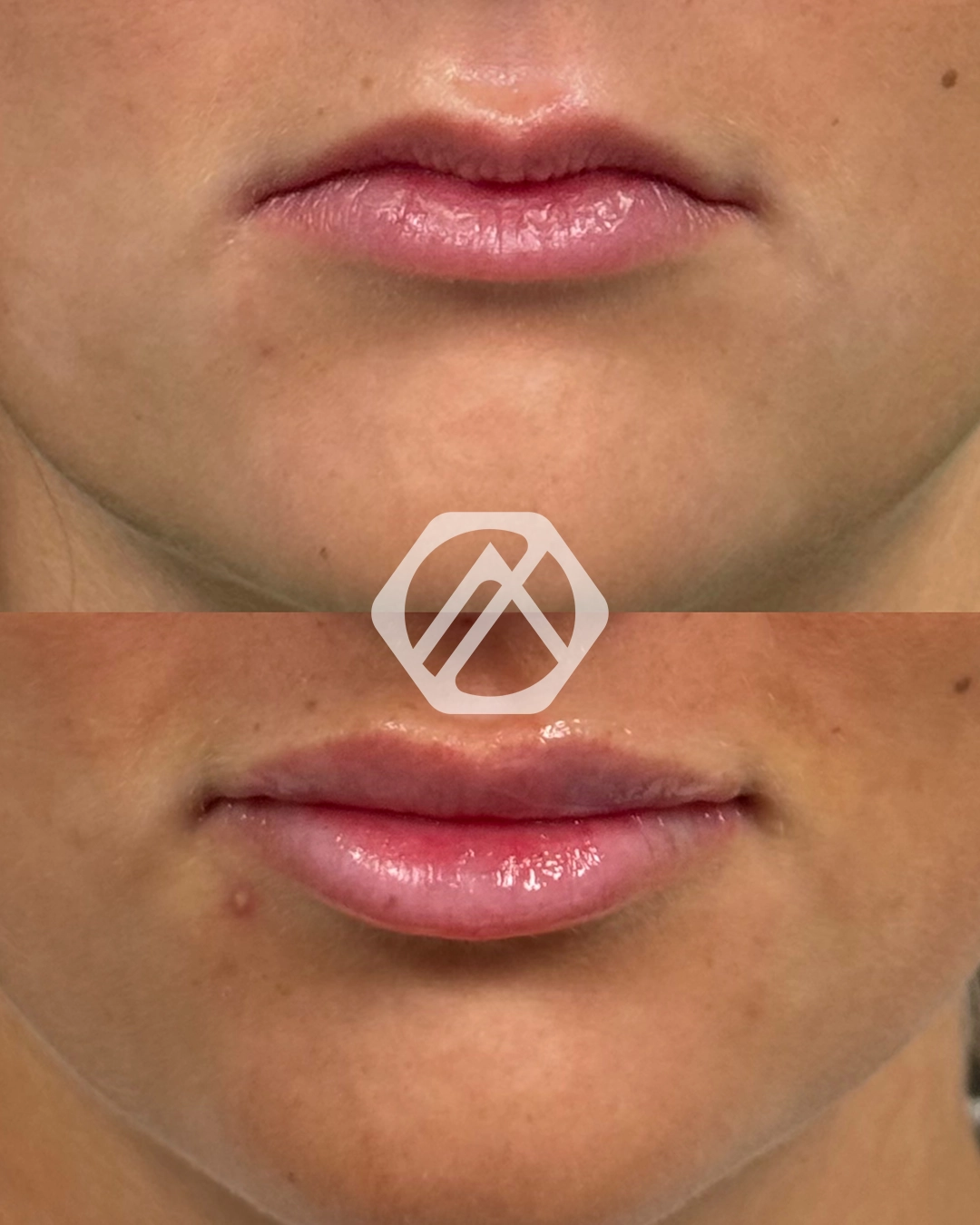 Lip filler