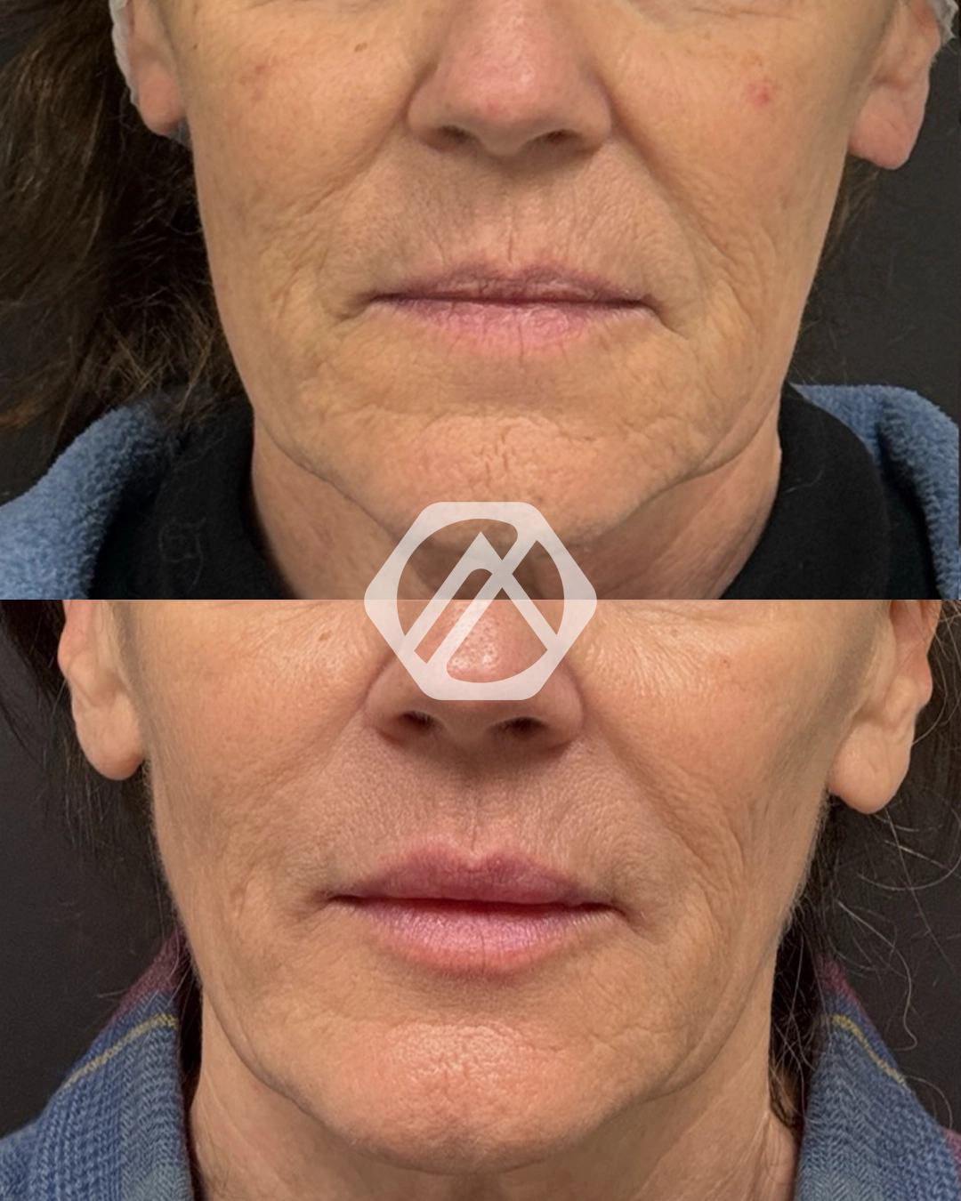 Facial Balancing