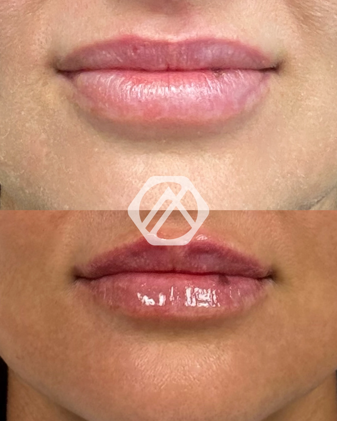 Lip filler