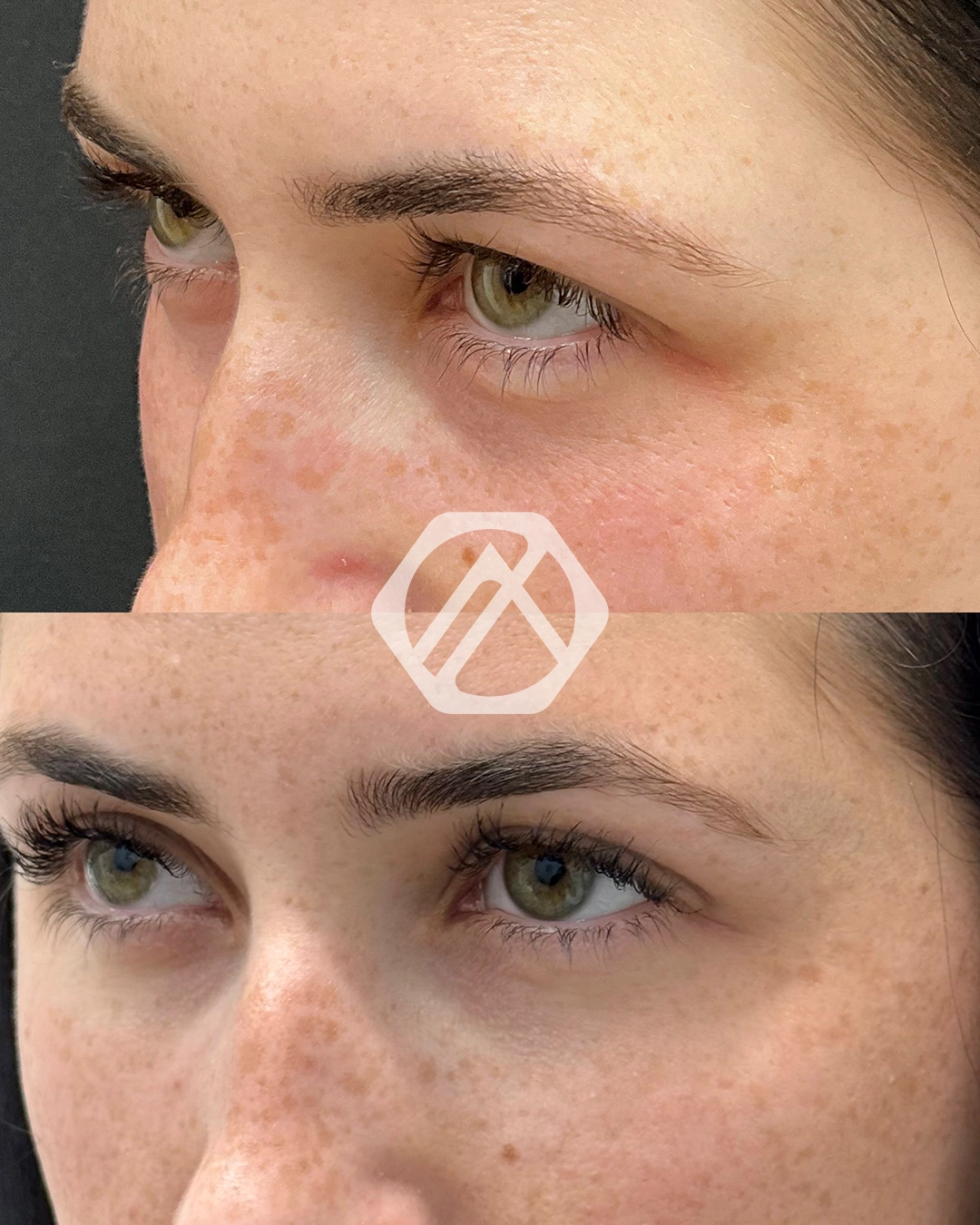 Undereye