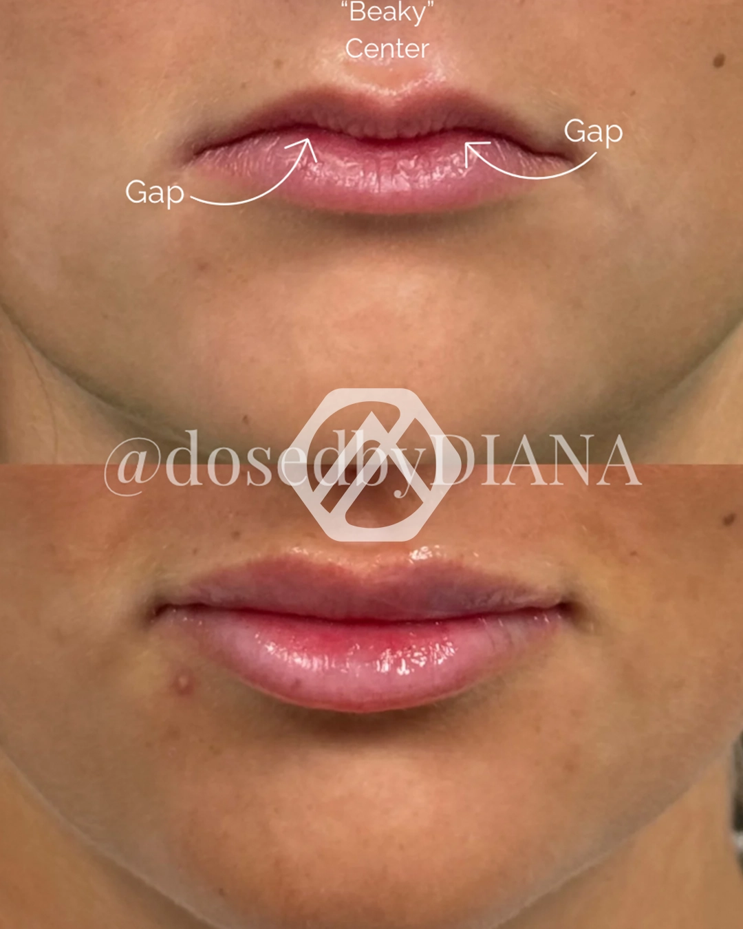 Lip filler