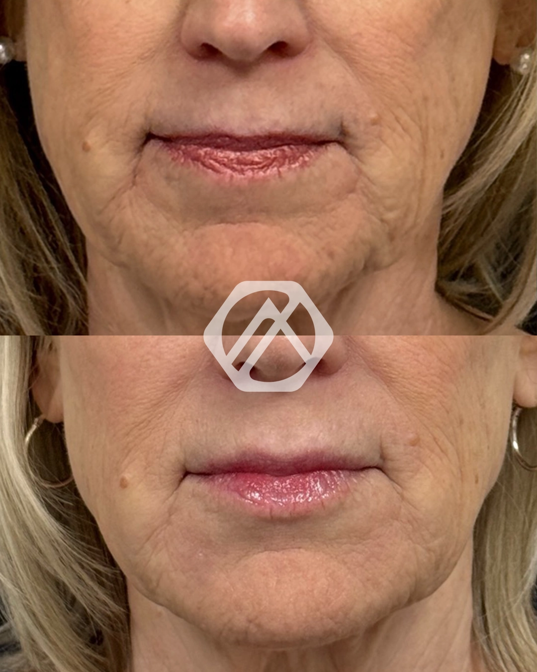 Facial Balancing