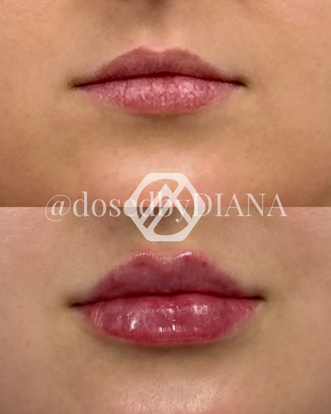 Lip filler