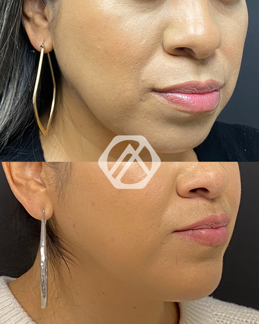 Facial Balancing