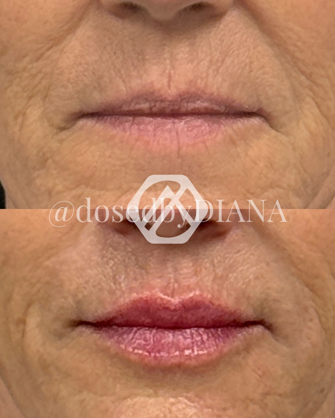 Lip filler