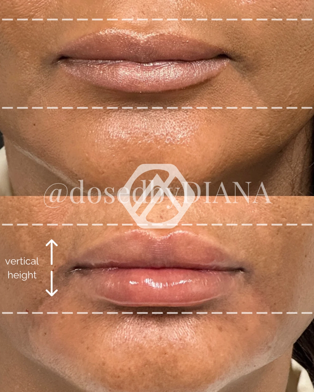 Lip filler