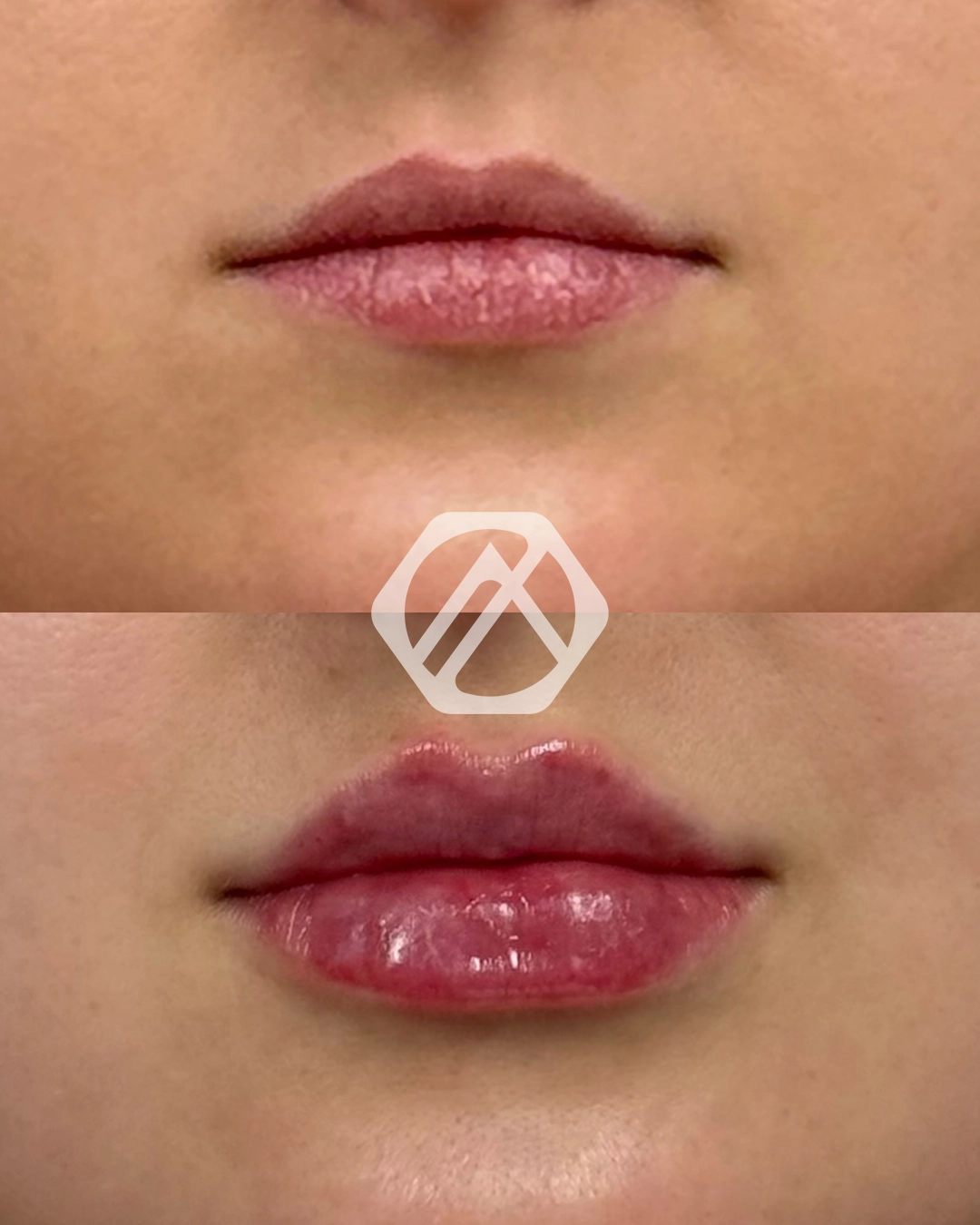 Lip filler