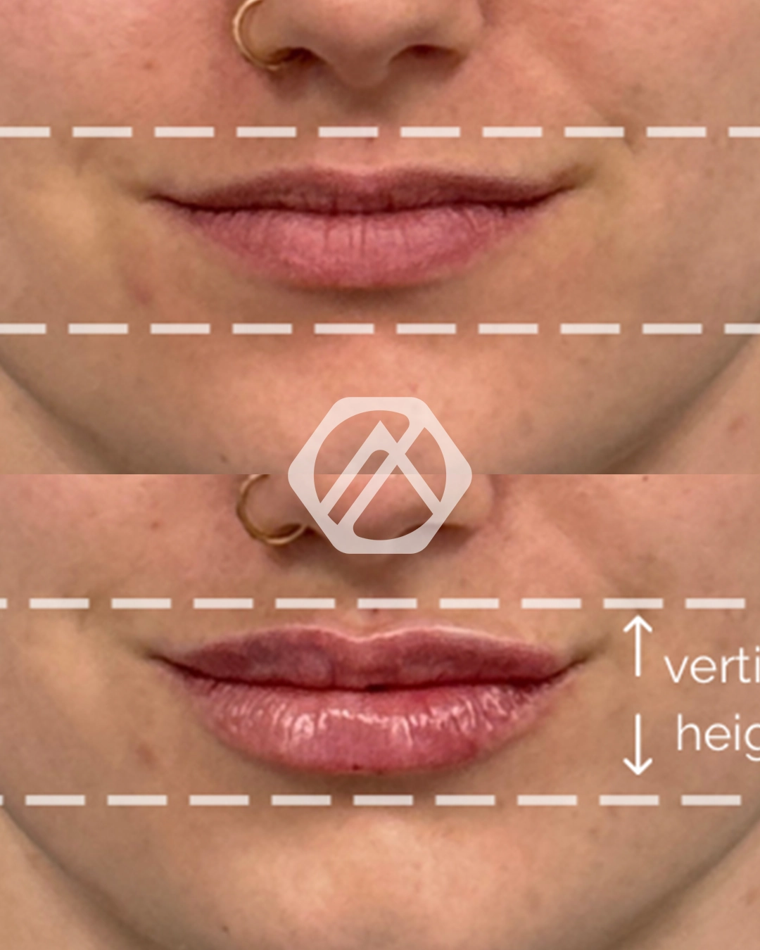 Lip filler
