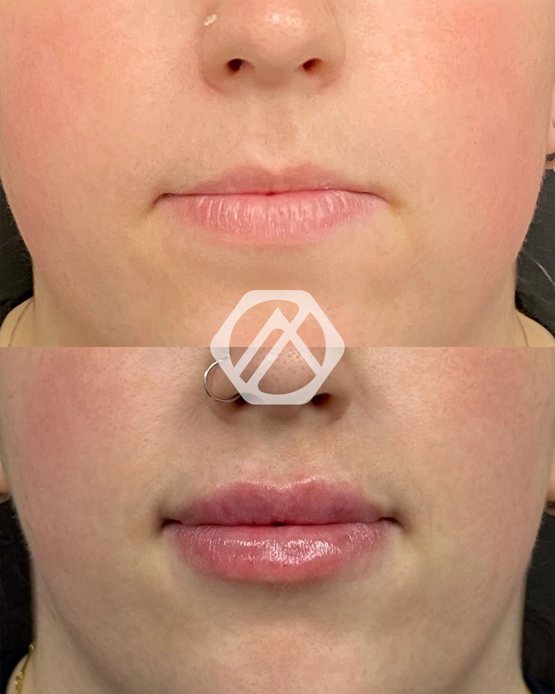 Lip filler