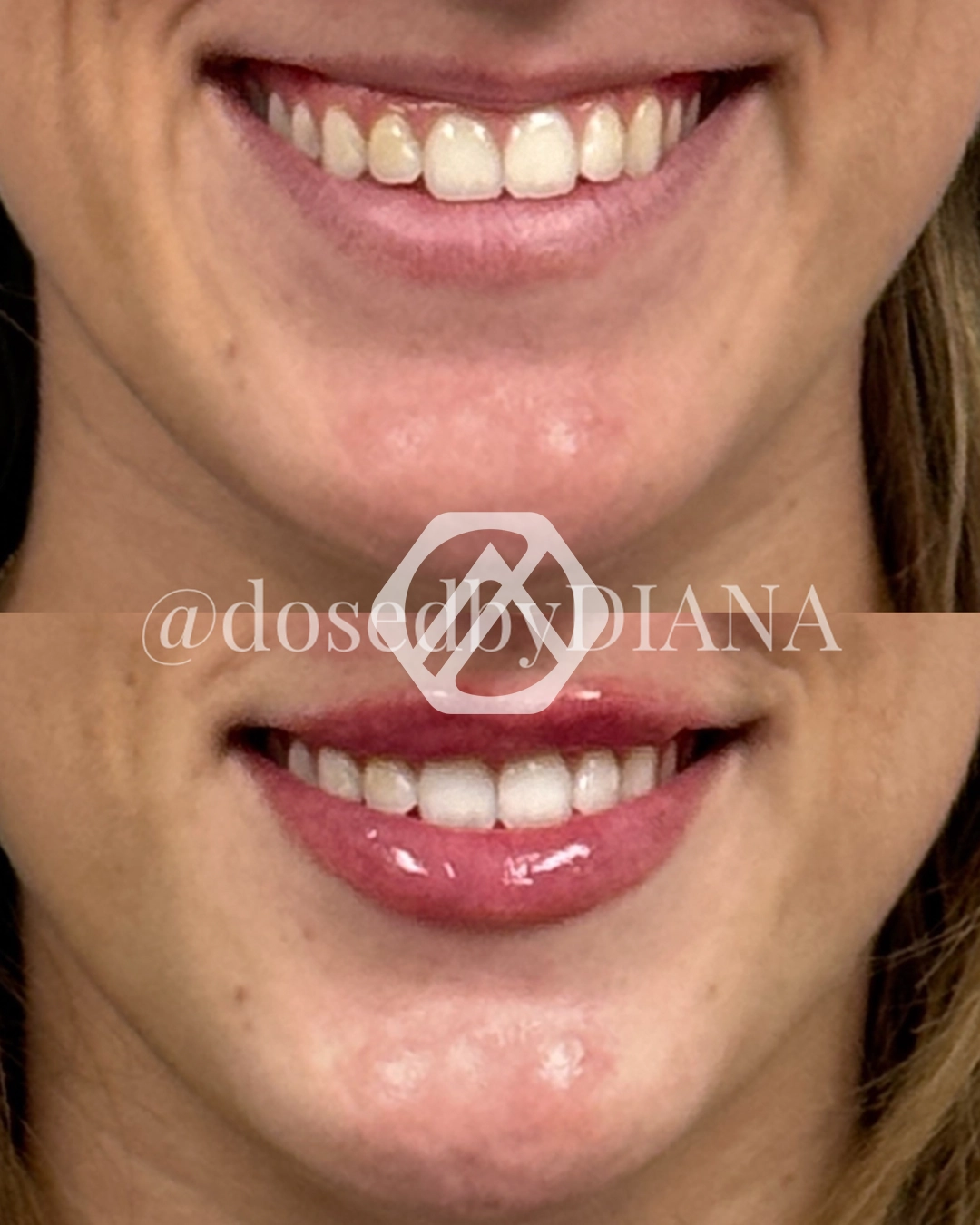 Lip filler