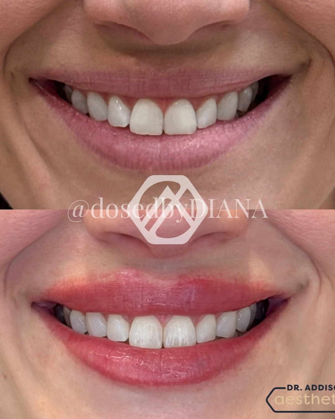 Lip filler