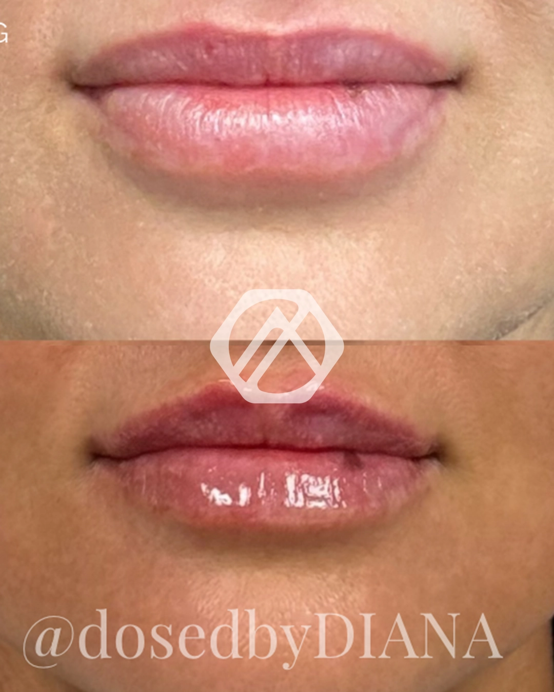 Lip filler