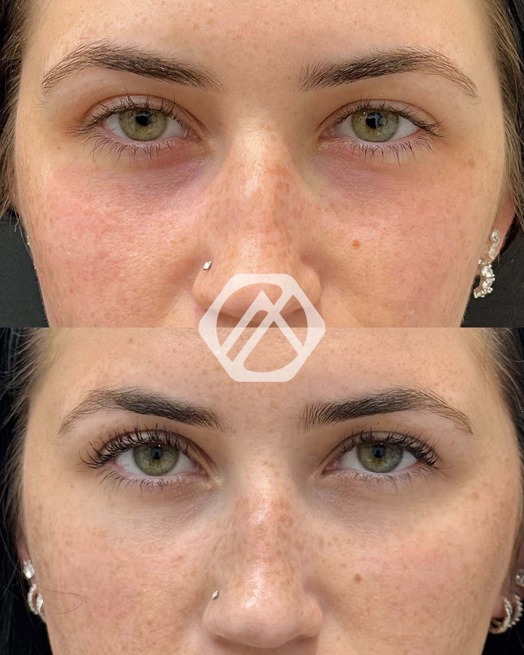 Undereye