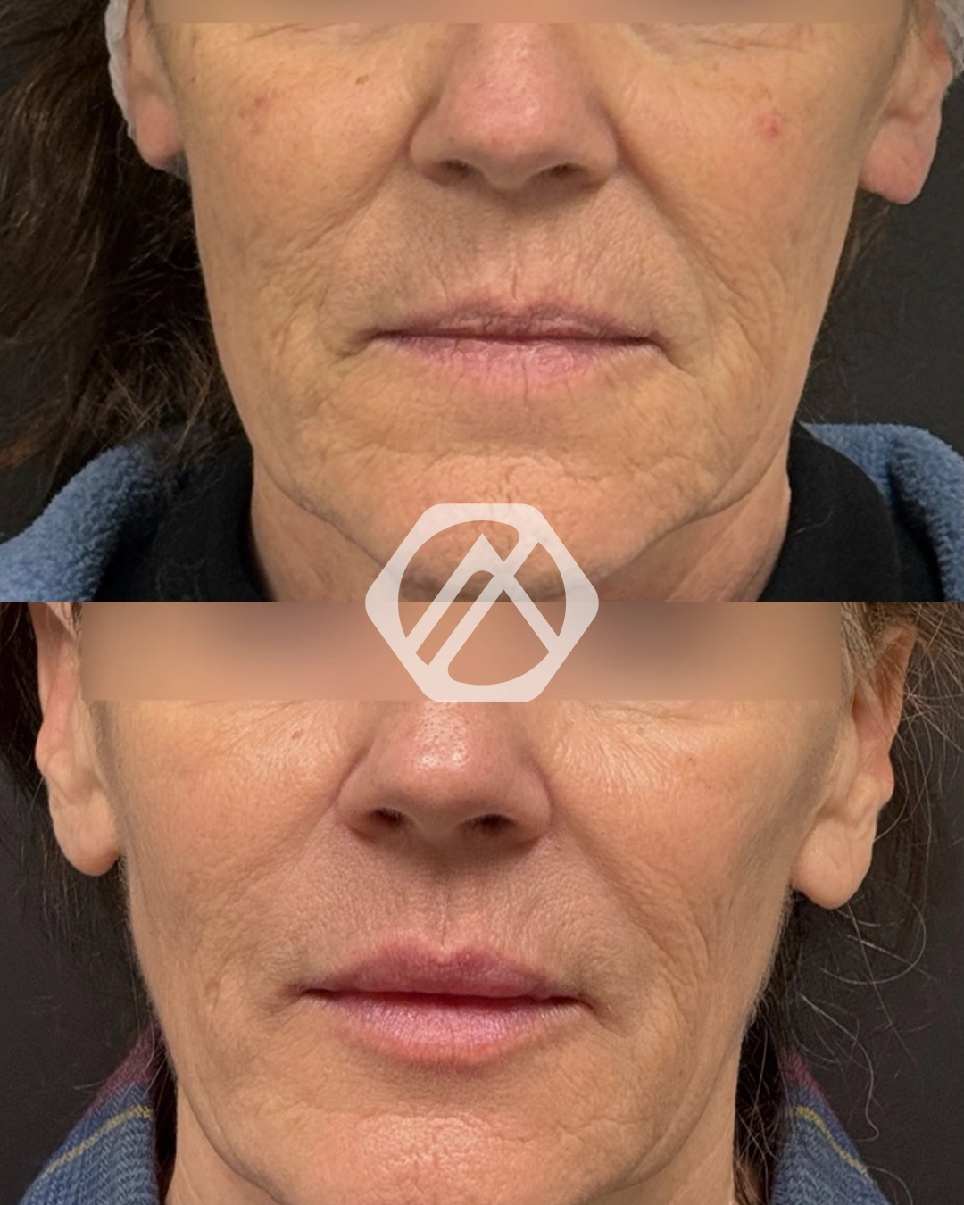 Facial Balancing