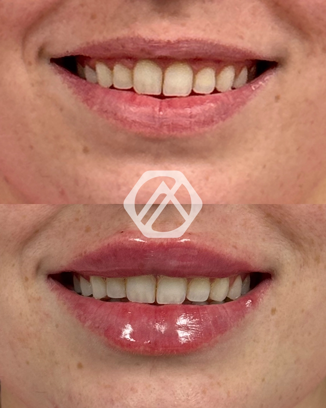 Lip filler