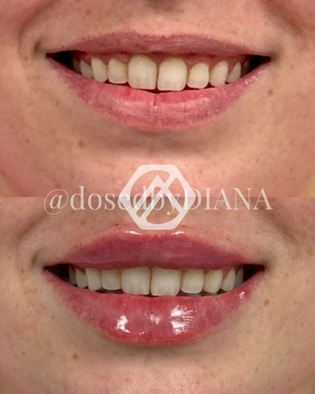 Lip filler