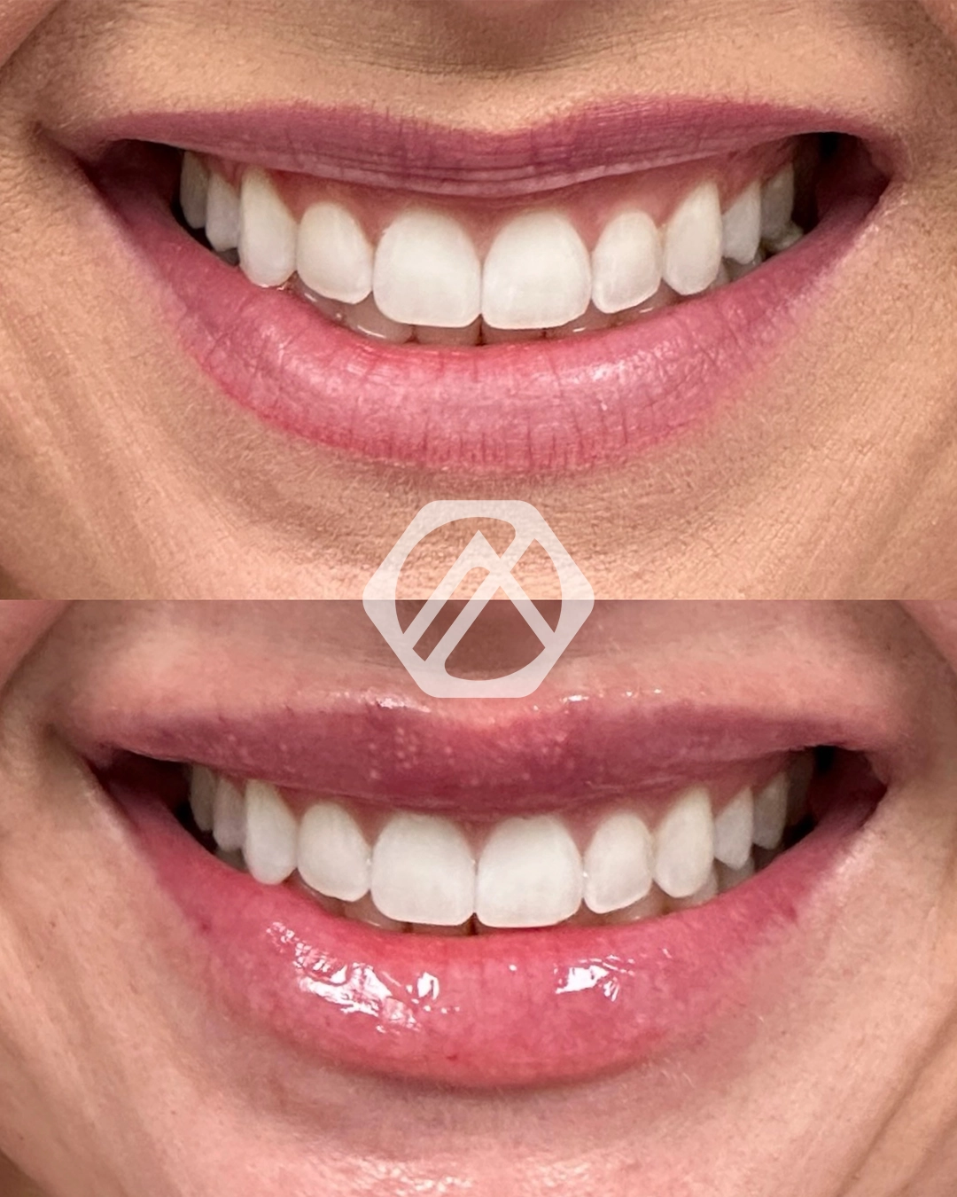 Lip filler