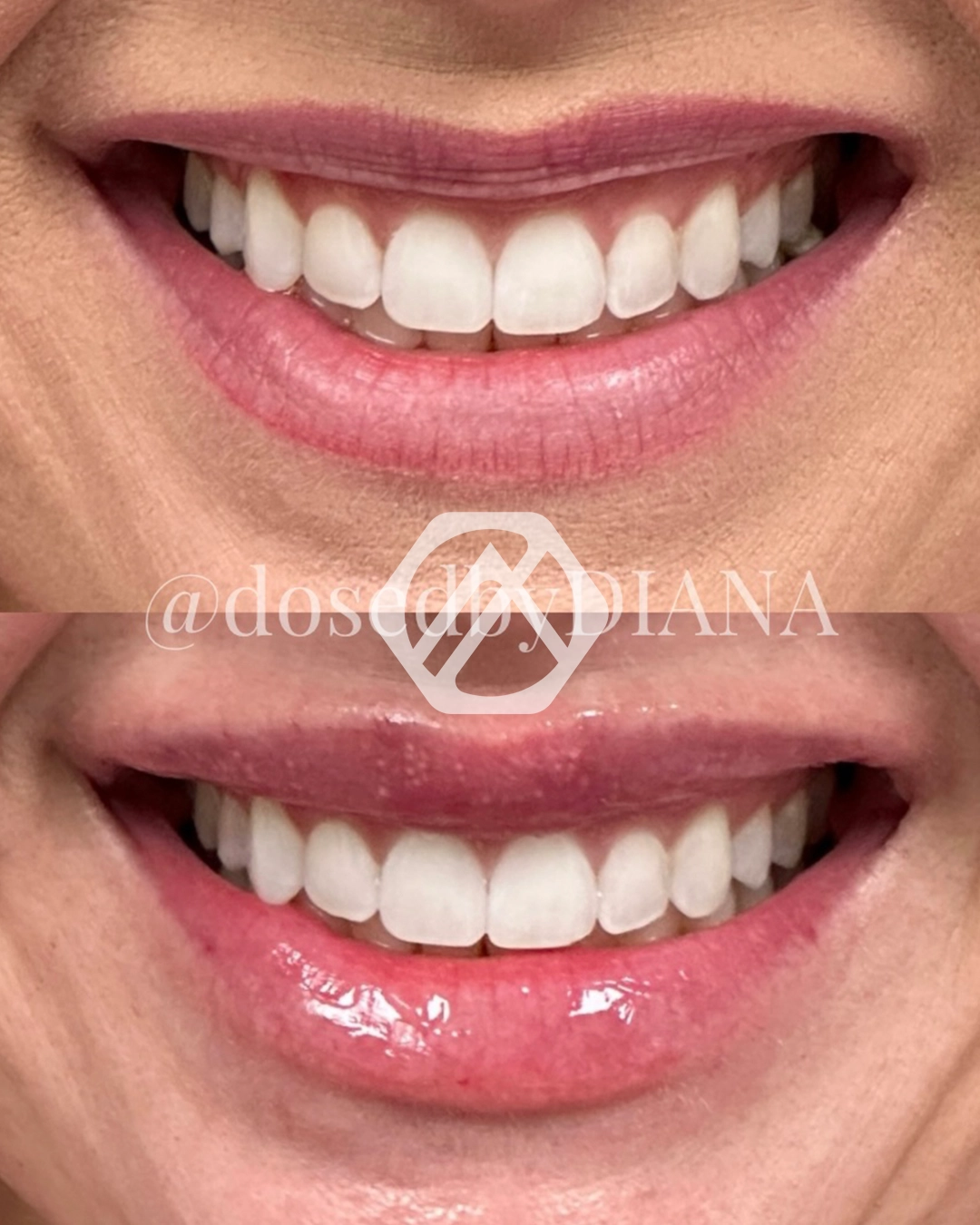 Lip filler