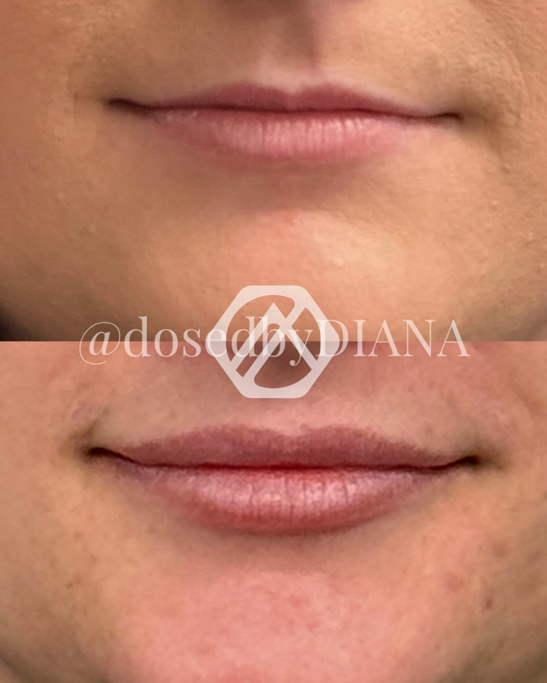Lip filler