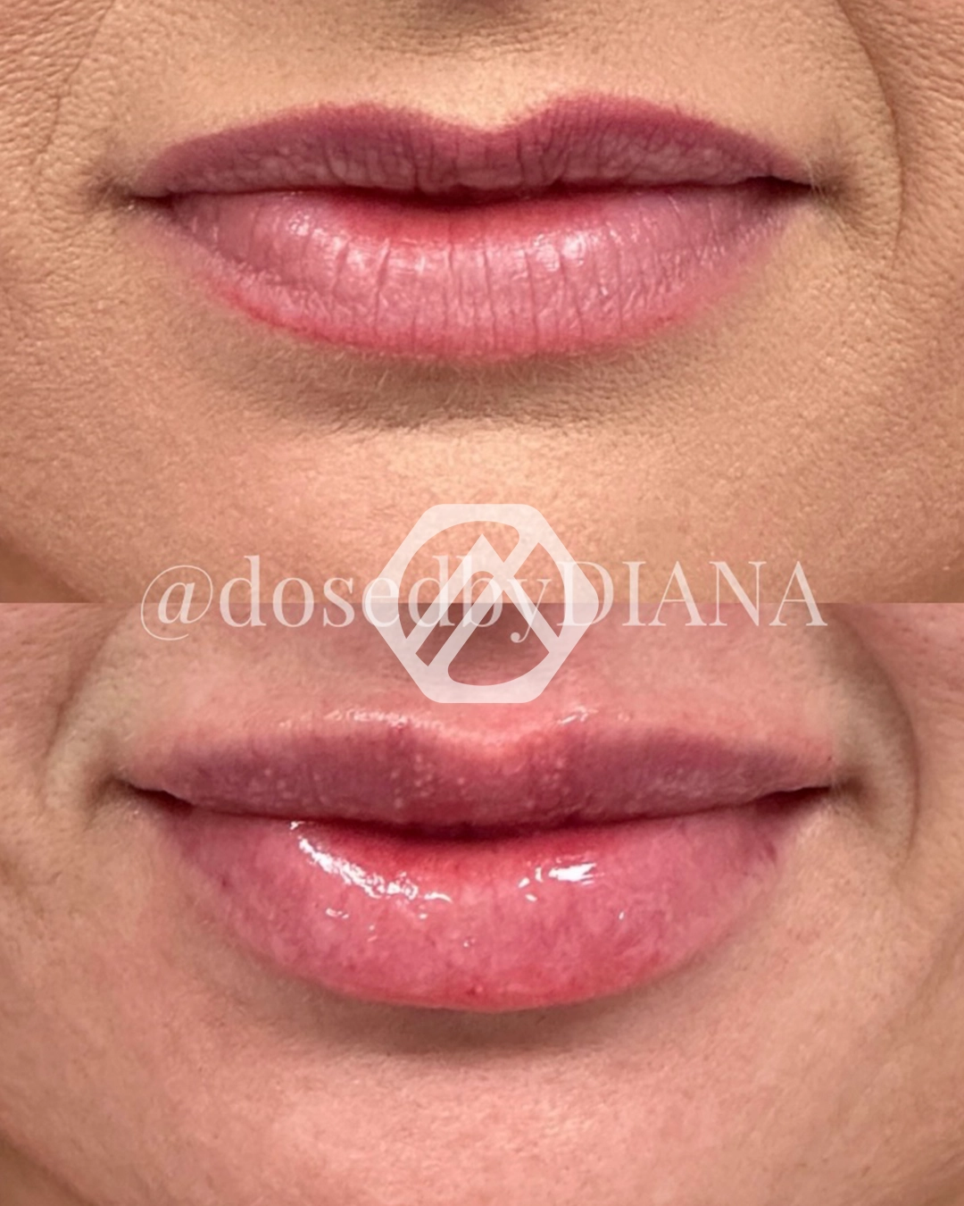 Lip filler