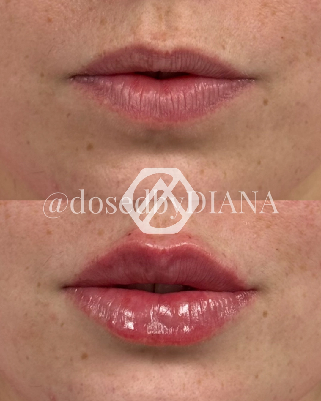 Lip filler