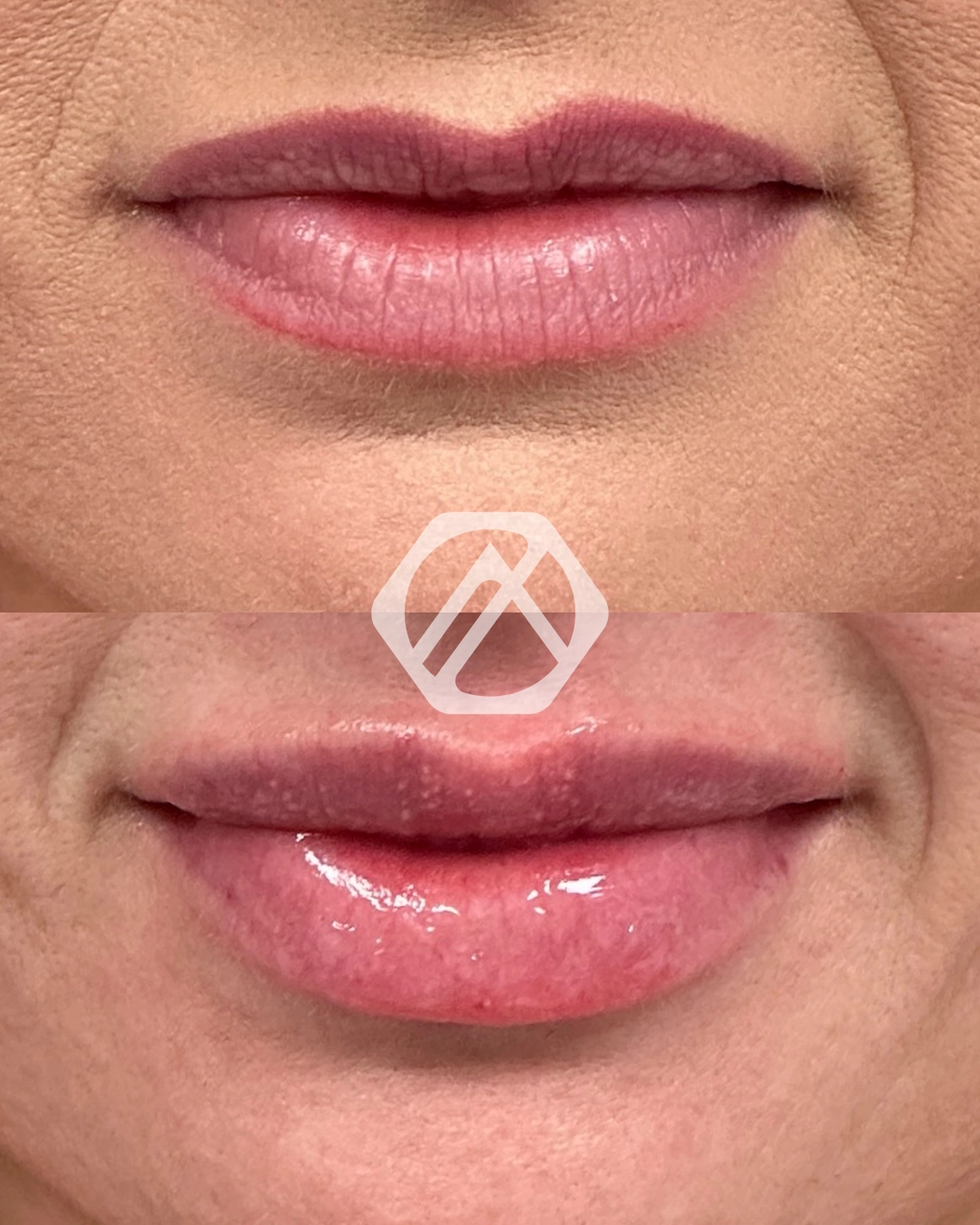 Lip filler