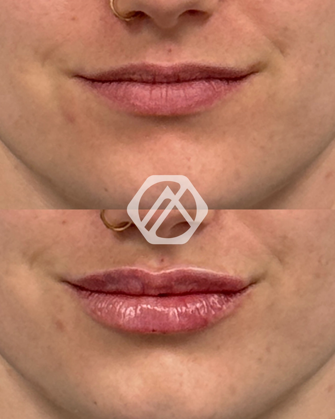 Lip filler
