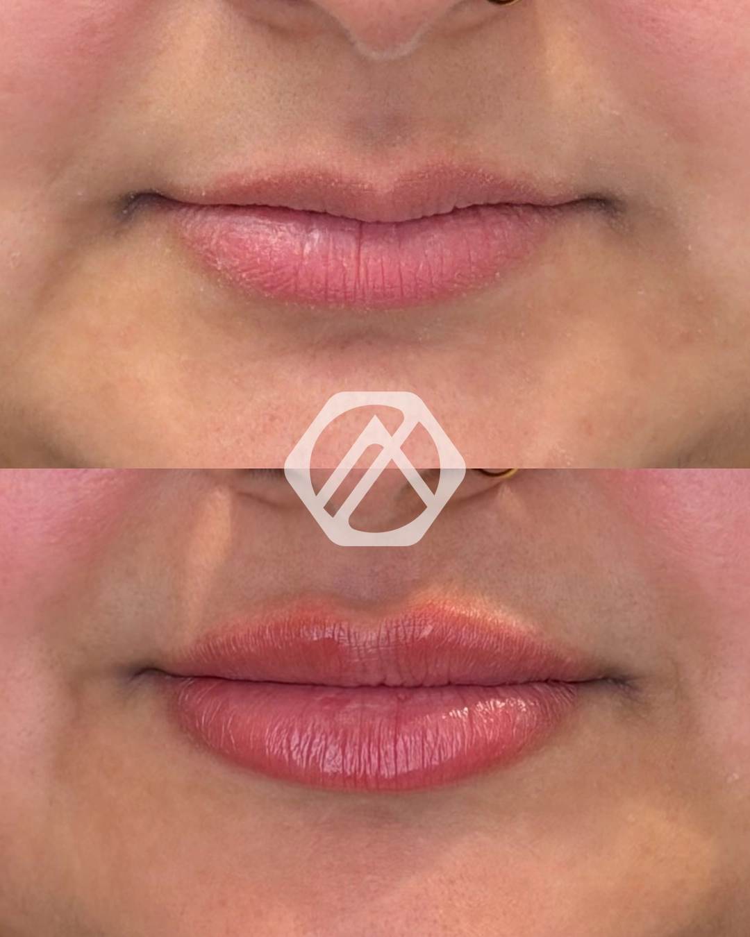 Lip filler