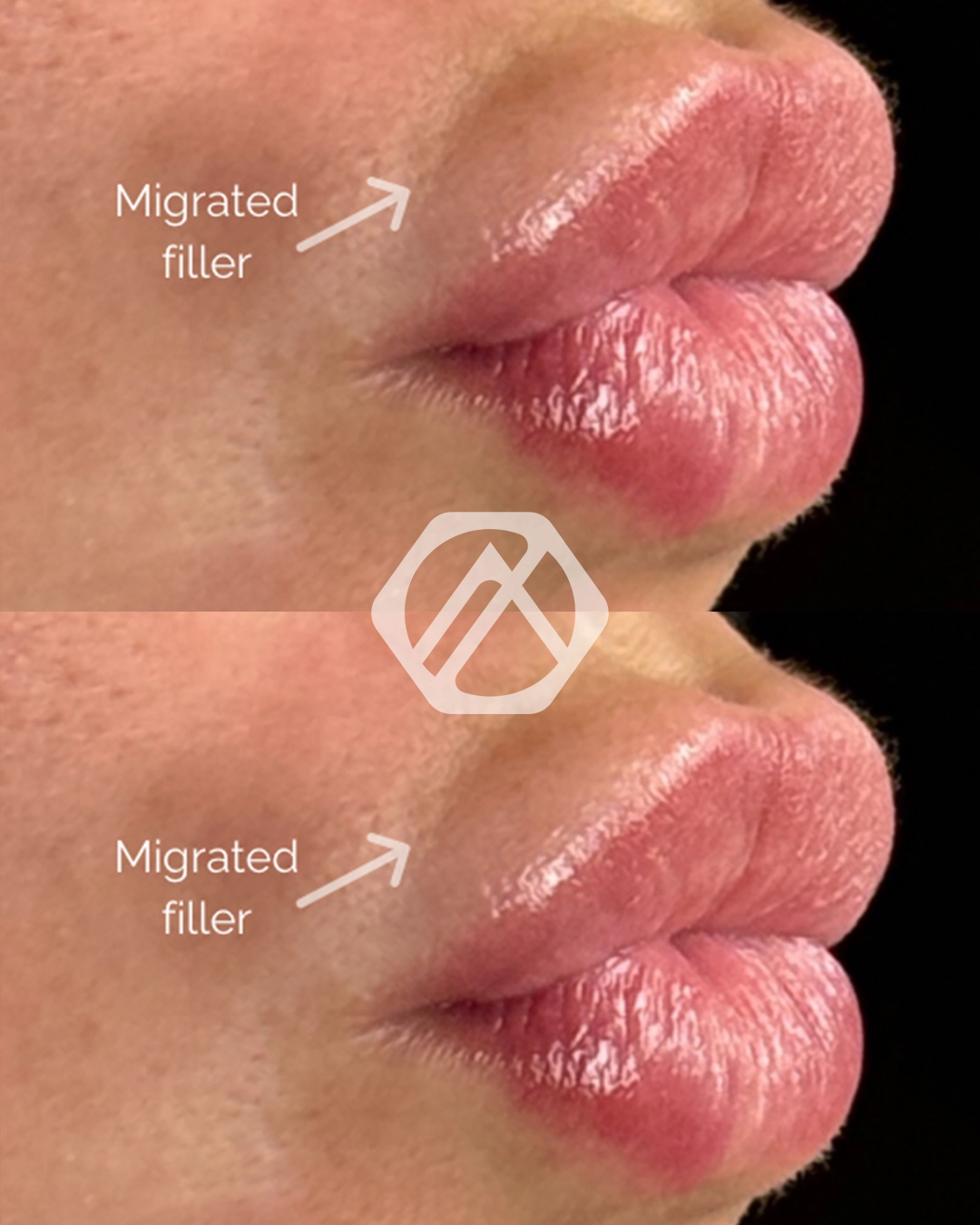Lip filler