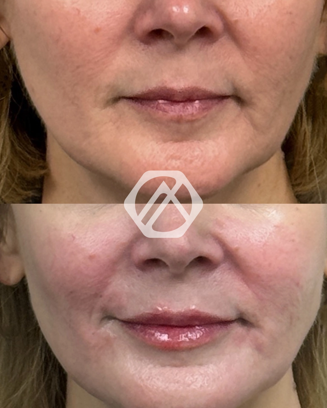 Lip filler