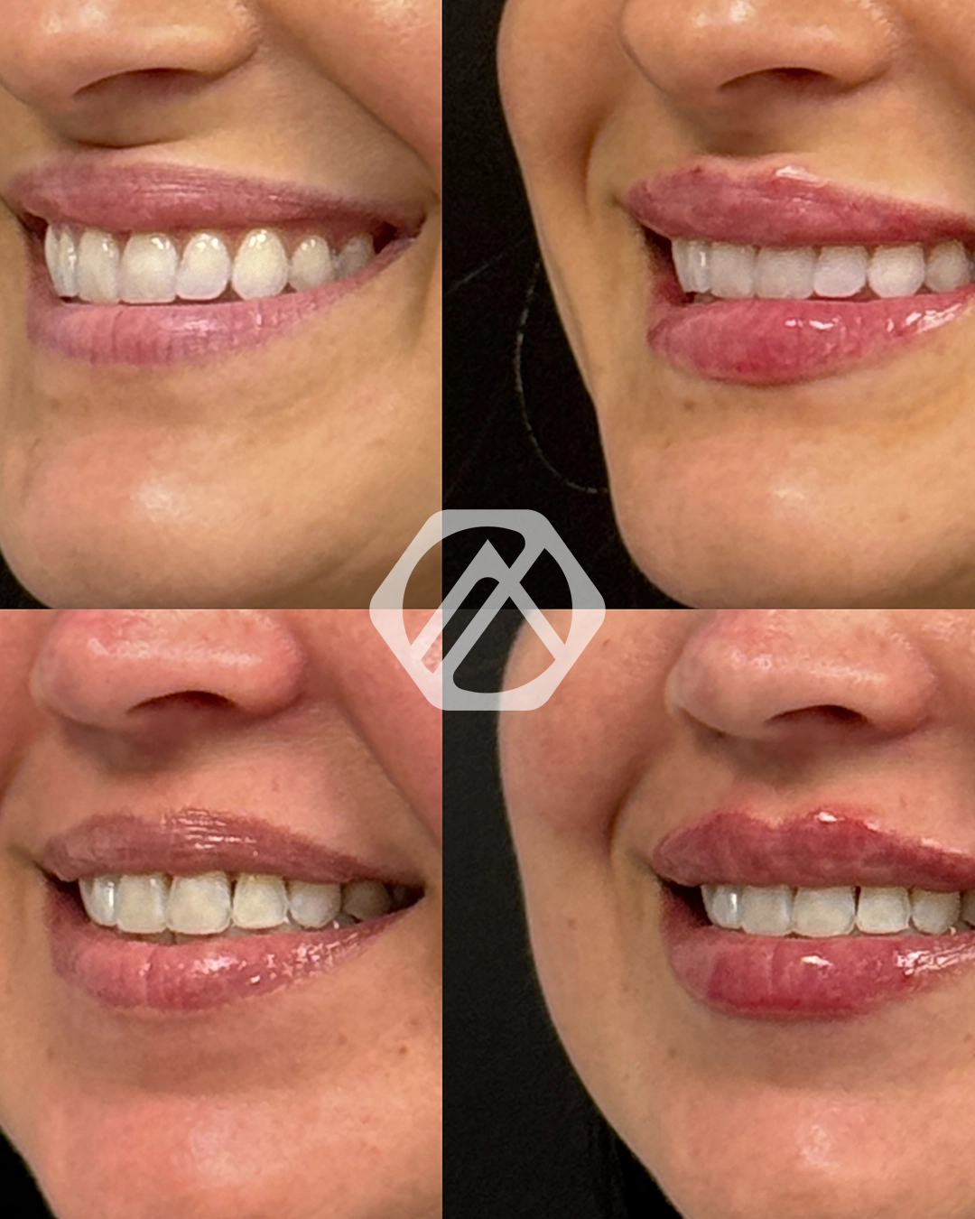 Lip filler