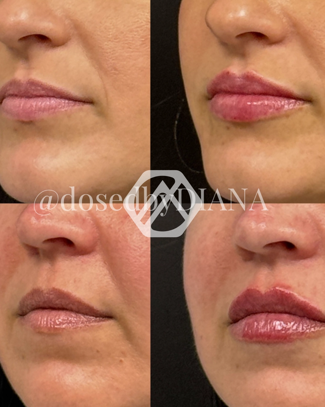 Lip filler