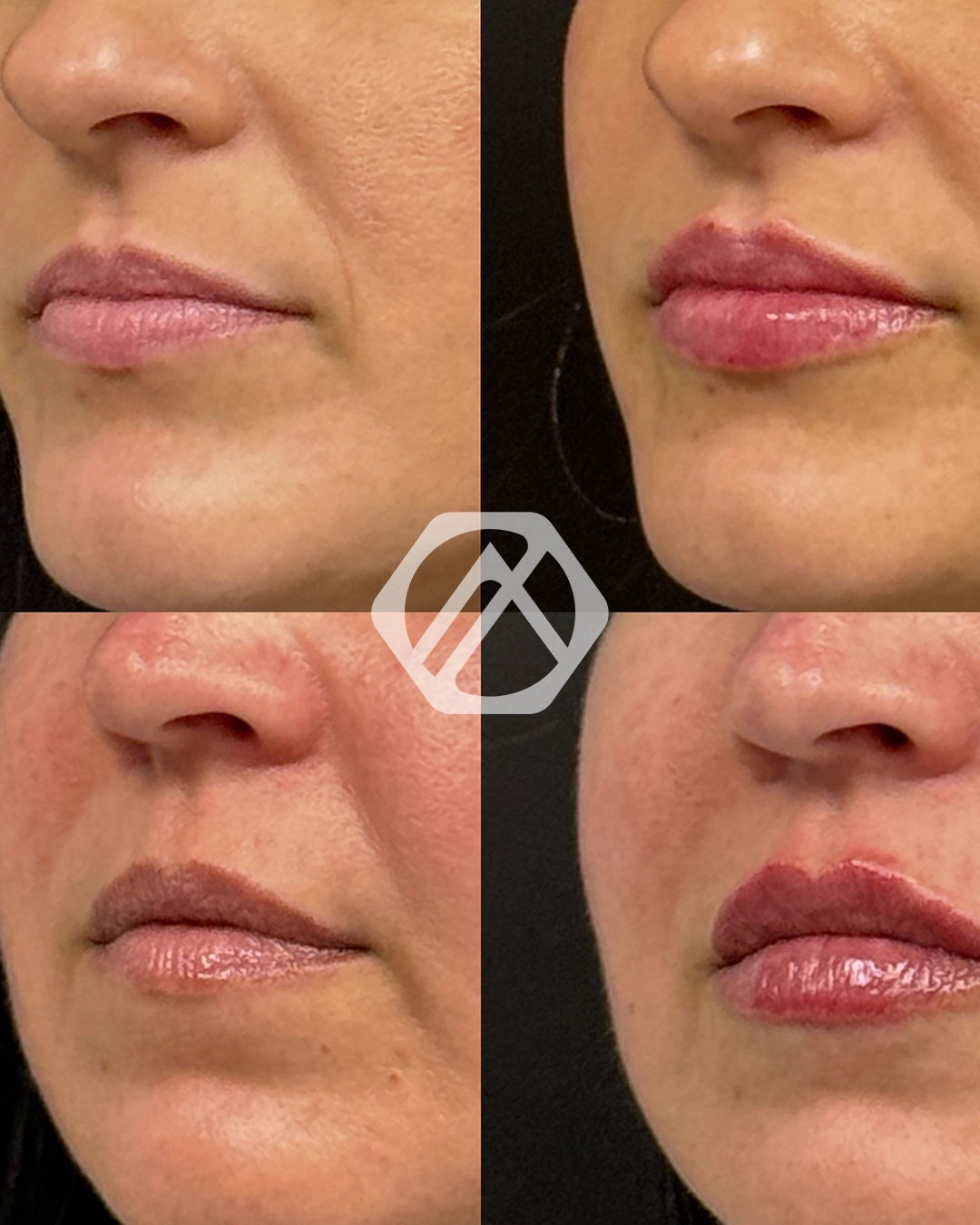 Lip filler