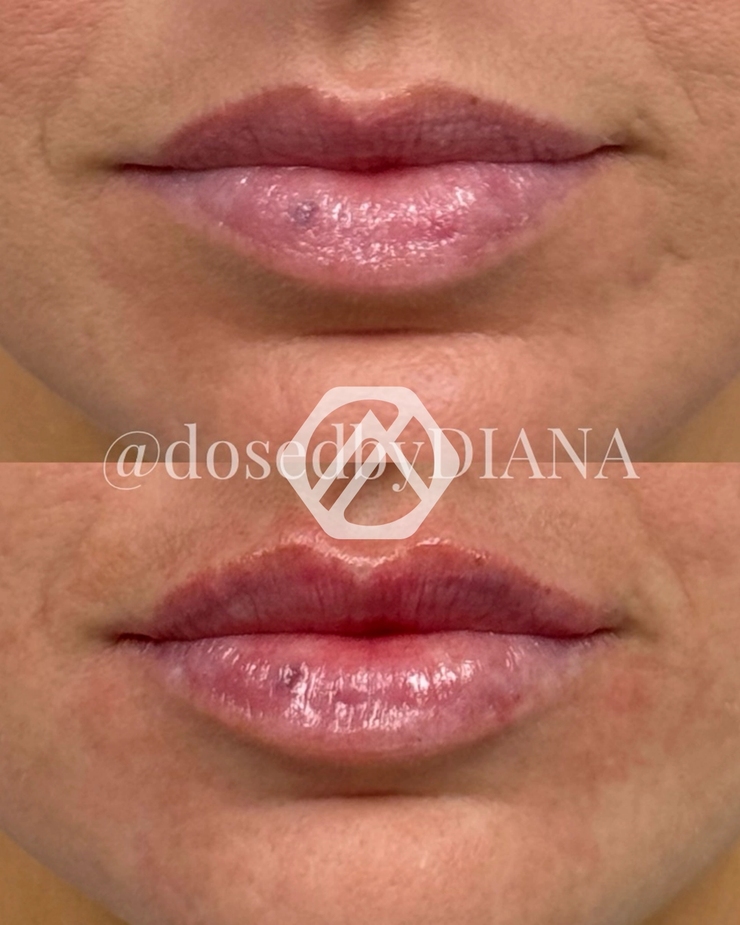 Lip filler
